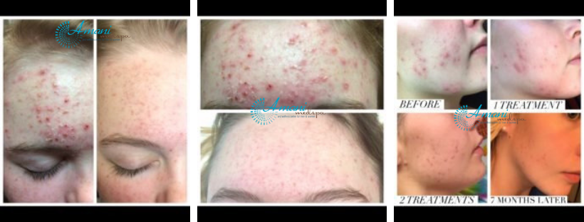A person who had acne treatment in Brandon, FL